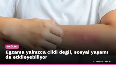 Egzama yalnızca cildi değil, sosyal yaşamı da etkileyebiliyor